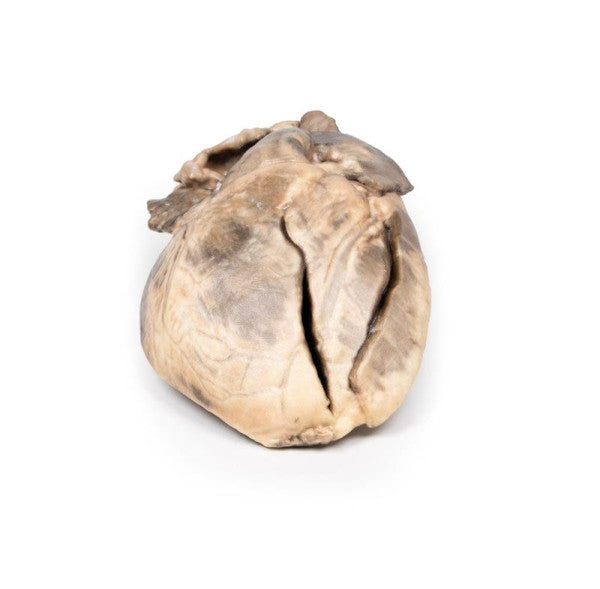 Heart Pathology 3D Printed Anatomy Model