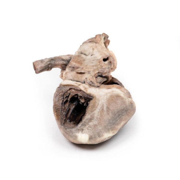 Heart Pathology 3D Printed Anatomy Model