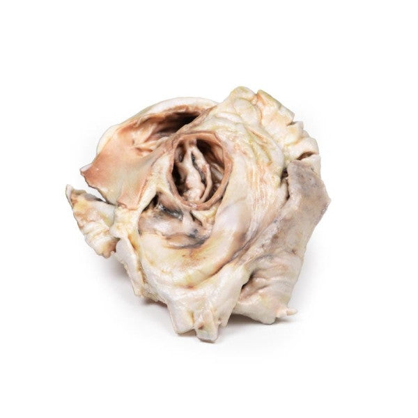 Calcified Aortic Valvular Stenosis (Bicuspid Aortic Valve) Model