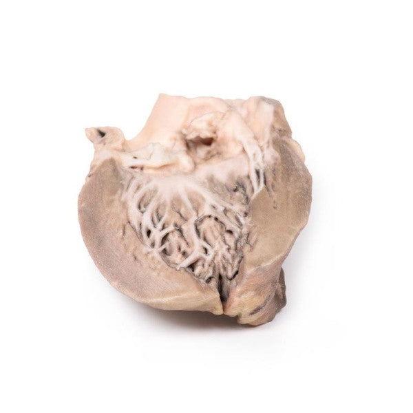 Endocarditis 3D Printed Anatomy Model