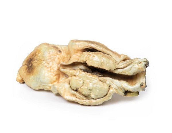 Carcinoma 3D Printed Anatomy Model