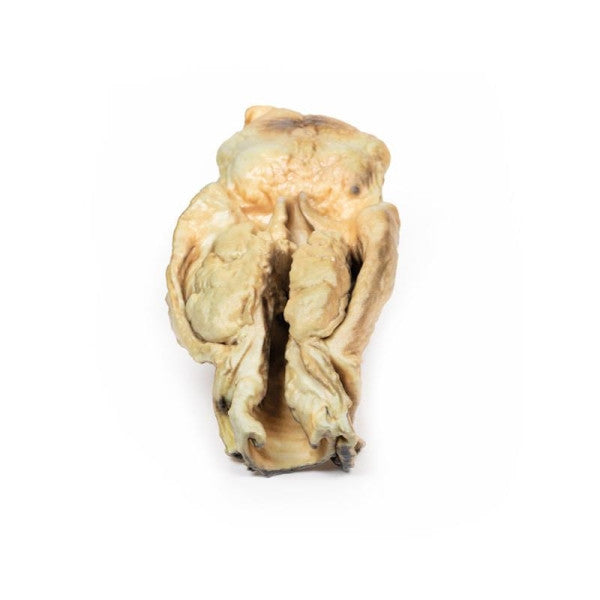 Carcinoma 3D Printed Anatomy Model