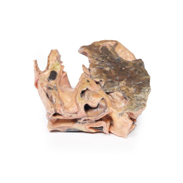 Inhaled Foreign Body Trachea 3D Printed Anatomy Model