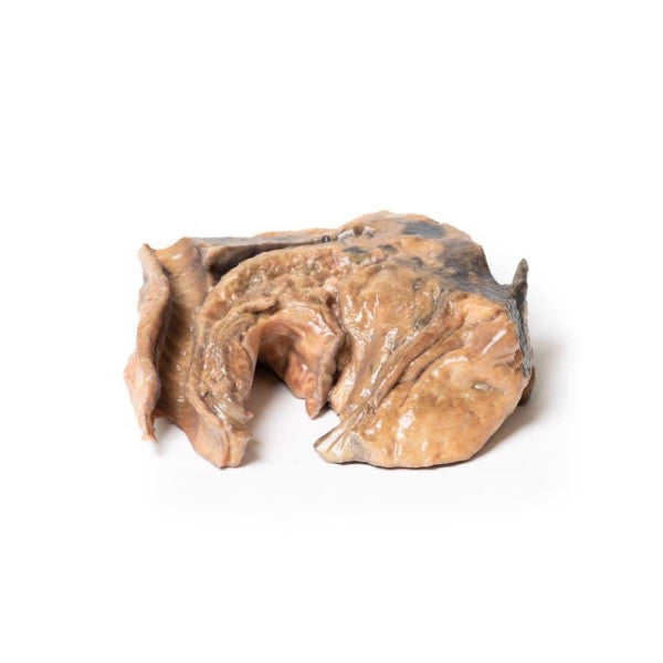 Inhaled Foreign Body Trachea 3D Printed Anatomy Model