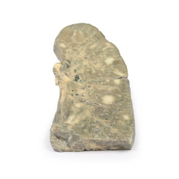 Carcinoma 3D Printed Anatomy Model