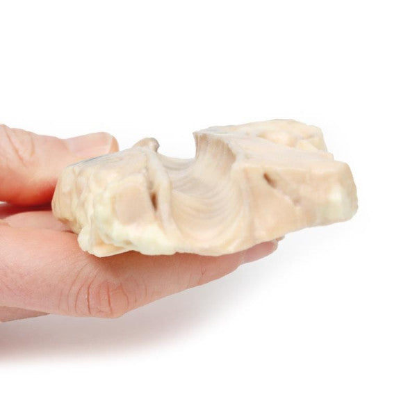 Lymphoma 3D Printed Anatomy Model