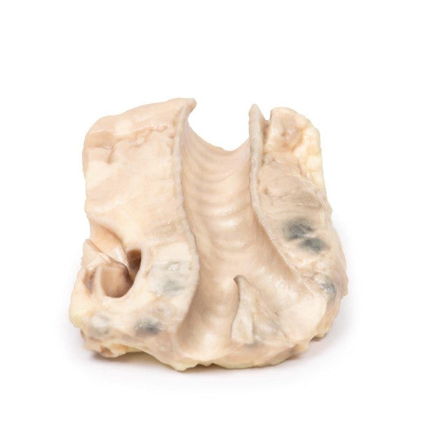 Lymphoma 3D Printed Anatomy Model