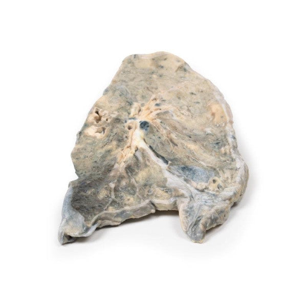 Lung 3D Printed Anatomy Model