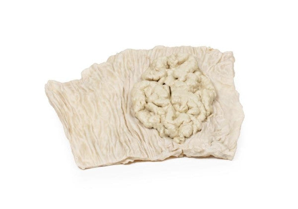 Adenoma 3D Printed Anatomy Model