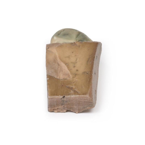 Cholelithiasis (Gallstones) 3D Printed Anatomy Model