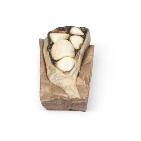 Cholelithiasis (Gallstones) 3D Printed Anatomy Model