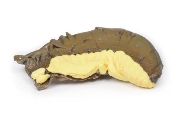 Bowel Pathology 3D Printed Anatomy Model