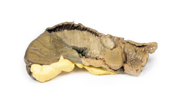 Bowel Pathology 3D Printed Anatomy Model