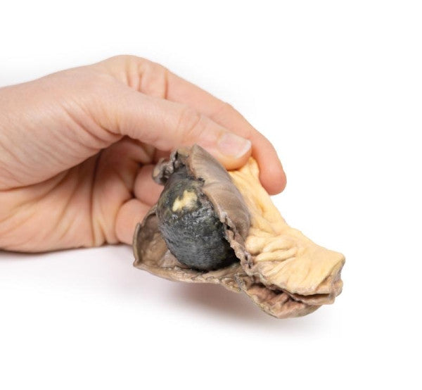 Cholelithiasis (Gallstones) 3D Printed Anatomy Model