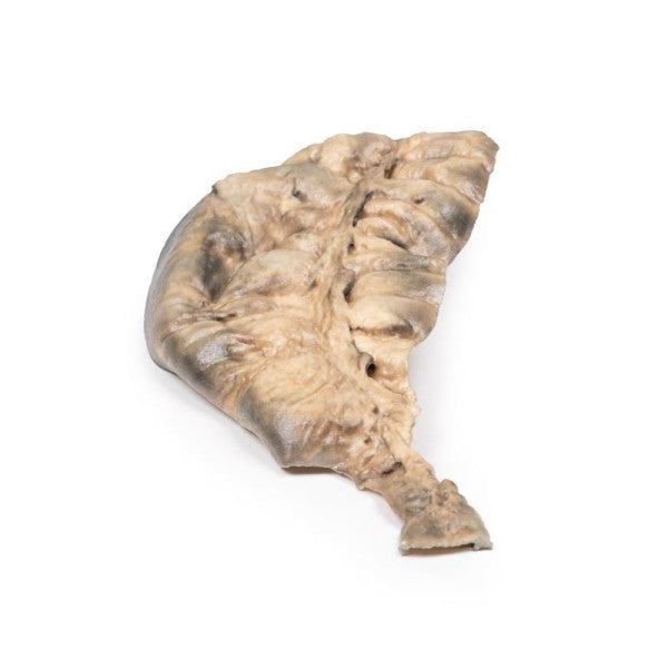 Bowel Pathology 3D Printed Anatomy Model