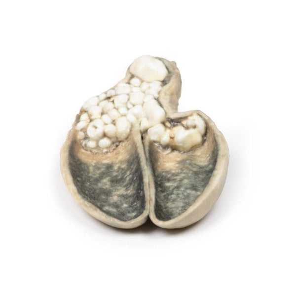 Cholelithiasis (Gallstones) 3D Printed Anatomy Model