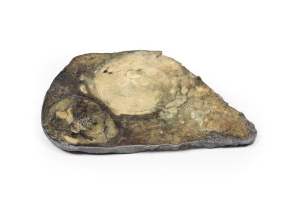 Carcinoma 3D Printed Anatomy Model