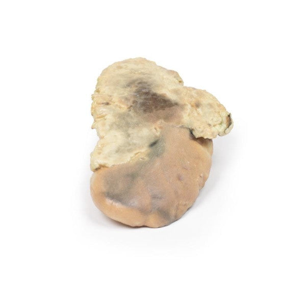 Adrenal Haemorrhage (Waterhouse-Friderichsen Syndrome) 3D Printed Anatomy Model