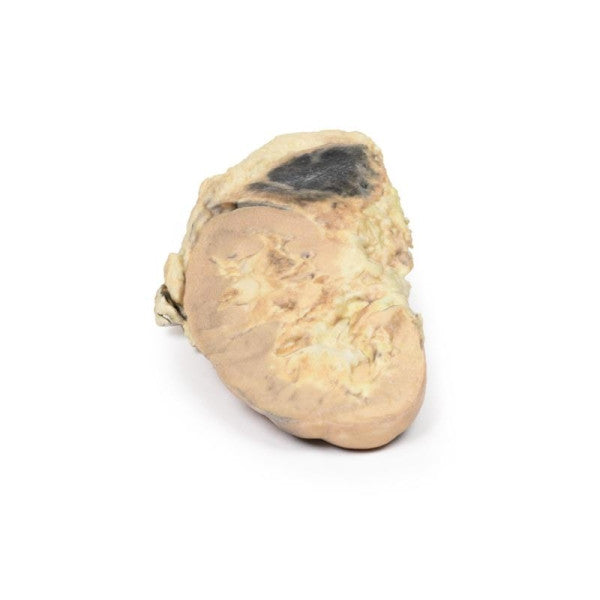 Adrenal Haemorrhage (Waterhouse-Friderichsen Syndrome) 3D Printed Anatomy Model