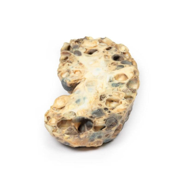 Renal Pathology 3D Printed Anatomy Model