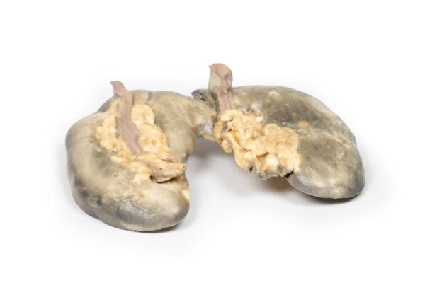 Renal Pathology 3D Printed Anatomy Model