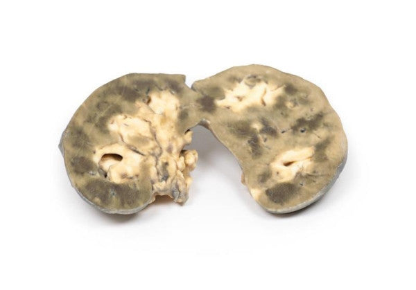 Renal Pathology 3D Printed Anatomy Model