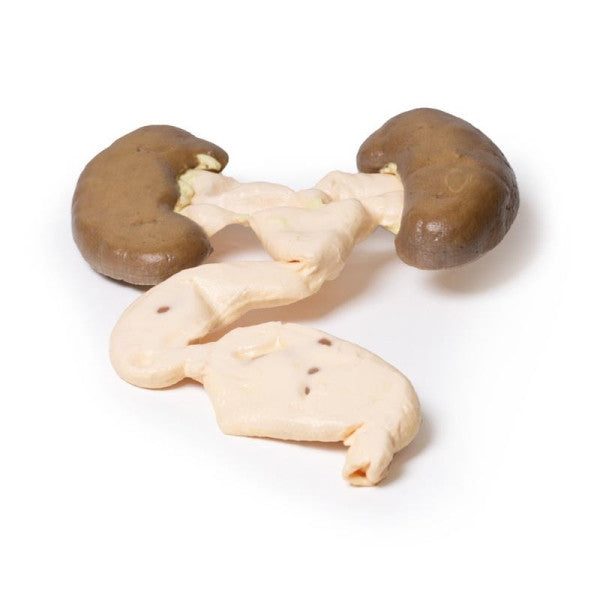 Hydronephrosis Hydroureter 3D Printed Anatomy Model