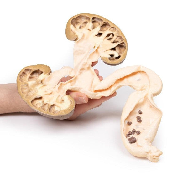 Hydronephrosis Hydroureter 3D Printed Anatomy Model