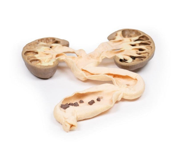 Hydronephrosis Hydroureter 3D Printed Anatomy Model