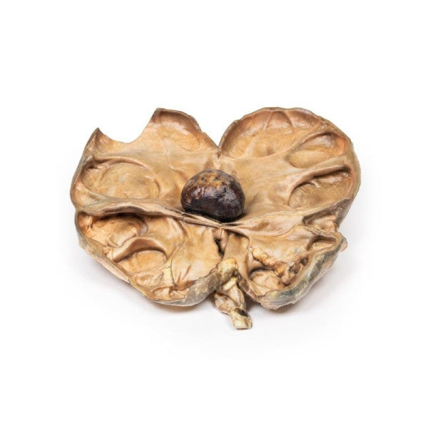 Hydronephrosis Hydroureter 3D Printed Anatomy Model