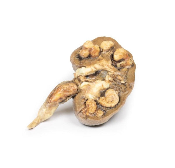 Renal Pathology 3D Printed Anatomy Model