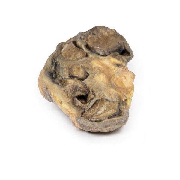 Renal Pathology 3D Printed Anatomy Model