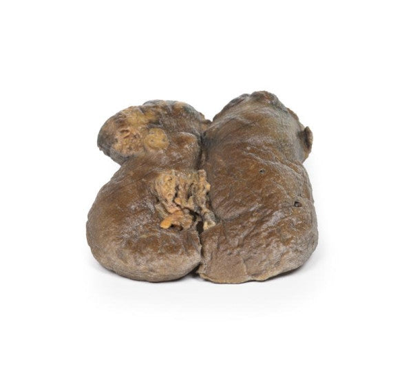 Carcinoma 3D Printed Anatomy Model