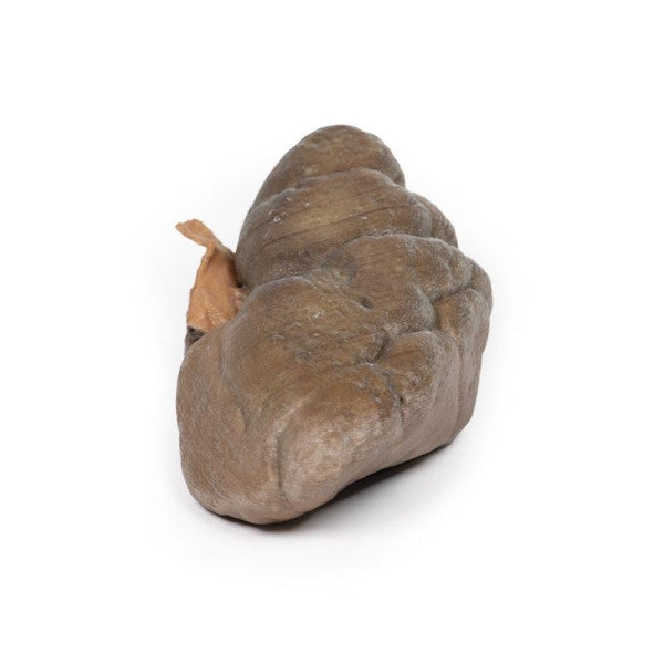 Carcinoma 3D Printed Anatomy Model