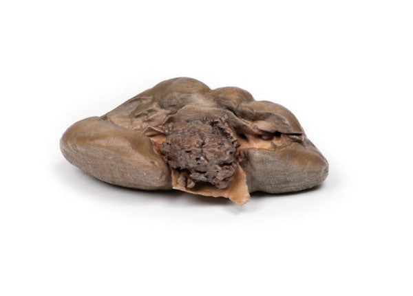 Carcinoma 3D Printed Anatomy Model