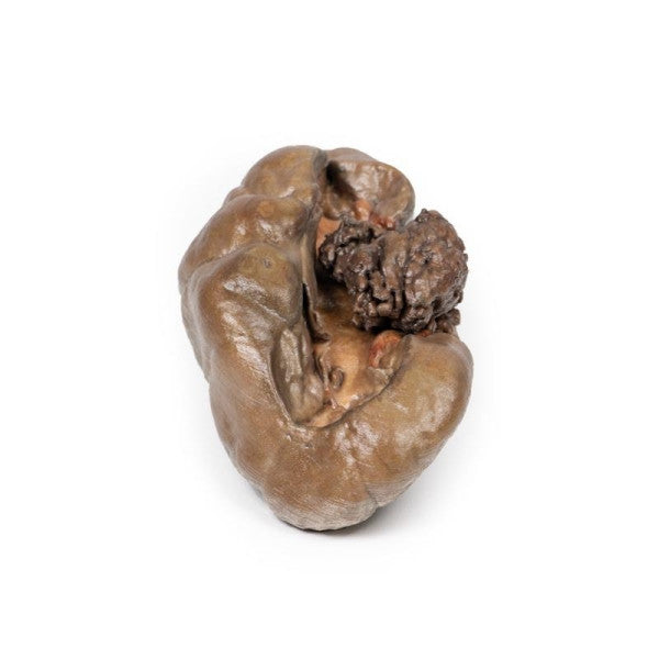 Carcinoma 3D Printed Anatomy Model