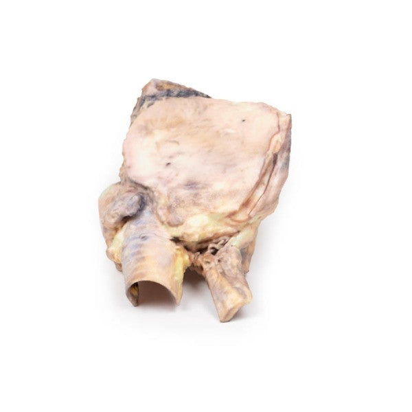 Lymphoma 3D Printed Anatomy Model