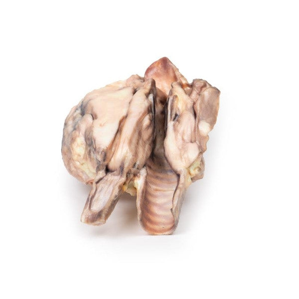 Lymphoma 3D Printed Anatomy Model