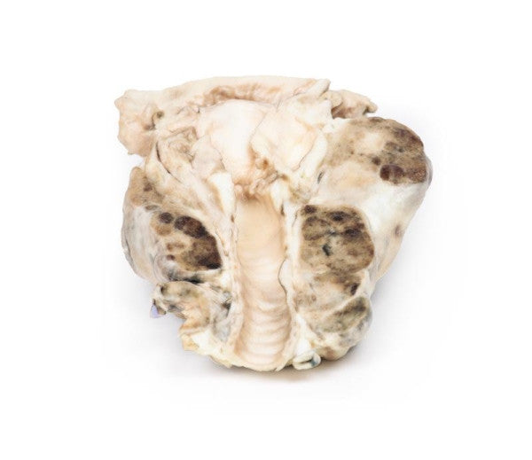 Goitre 3D Printed Anatomy Model