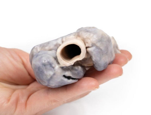 Goitre 3D Printed Anatomy Model