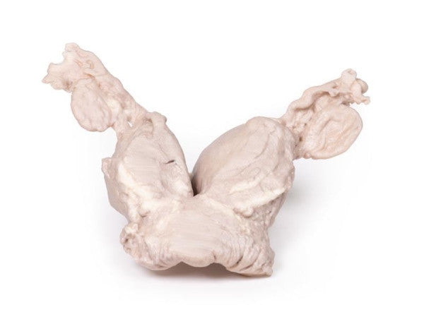 Uterus Pathology 3D Printed Anatomy Model