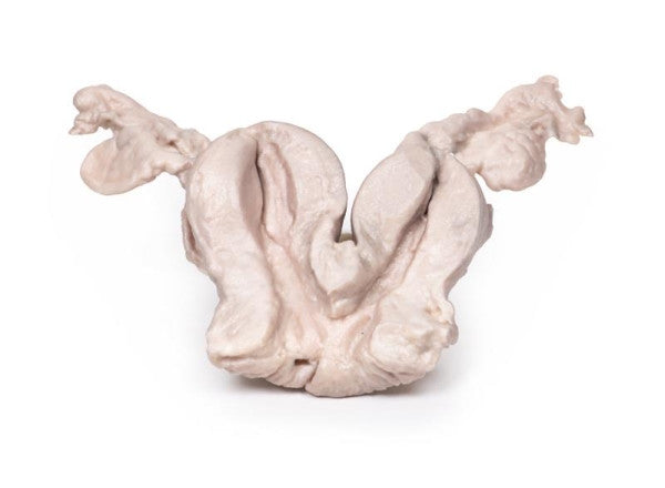 Uterus Pathology 3D Printed Anatomy Model