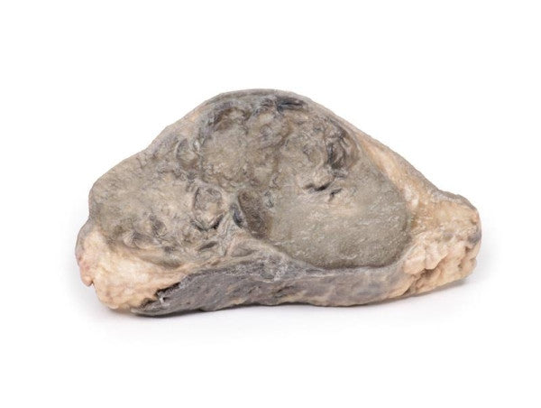 Carcinoma 3D Printed Anatomy Model