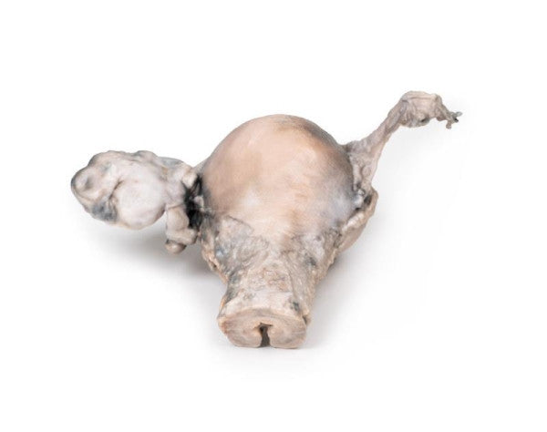 Carcinoma 3D Printed Anatomy Model