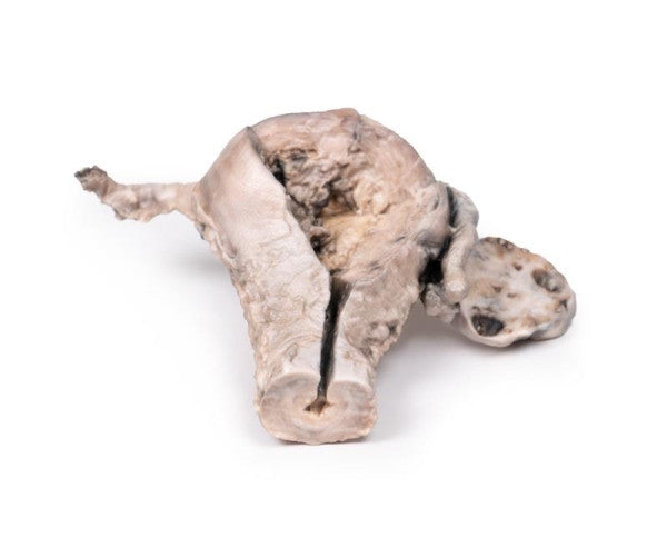 Carcinoma 3D Printed Anatomy Model