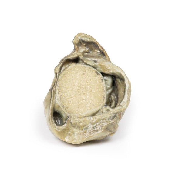 Hydrocoele 3D Printed Anatomy Model