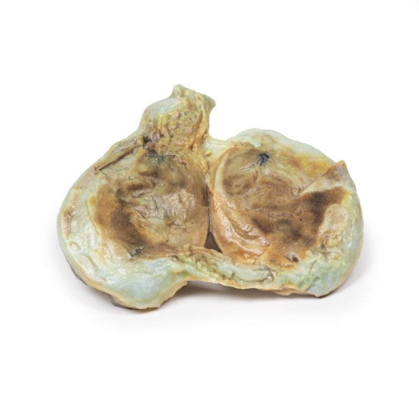 Hydrocoele 3D Printed Anatomy Model