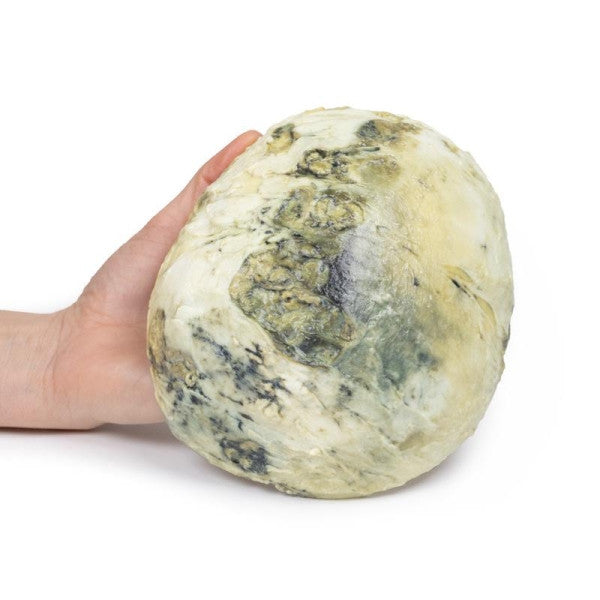 Tertiary Syphilis 3D Printed Anatomy Model