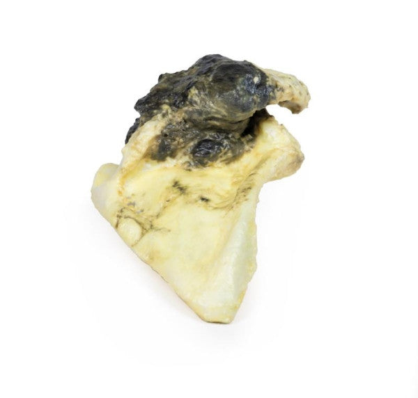 Chondrosarcoma 3D Printed Anatomy Model