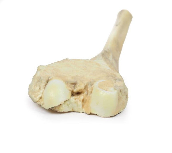 Osteosarcoma of Femur 3D Printed Anatomy Model